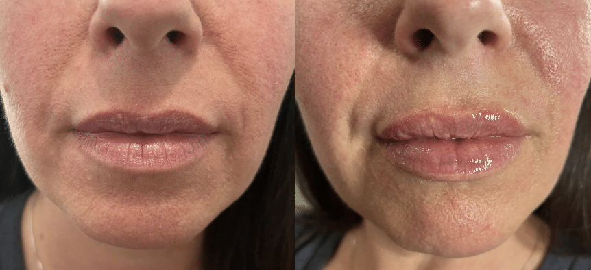 Dermal Filler for lips and cheeks