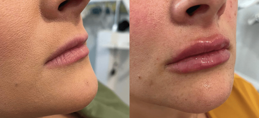 Dermal fillers for lips